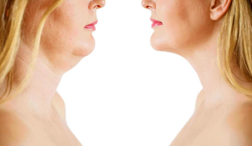 Double Chin treatment Malmesbury before and after results