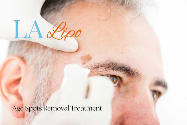What Are the Most Effective Treatments for Age Spots Malmesbury?