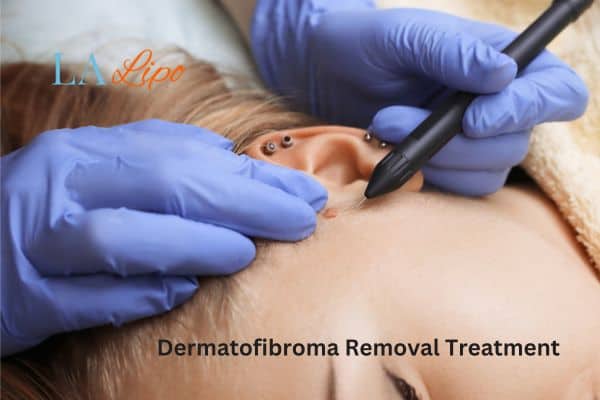 Dermatofibroma Removal Treatment Malmesbury
