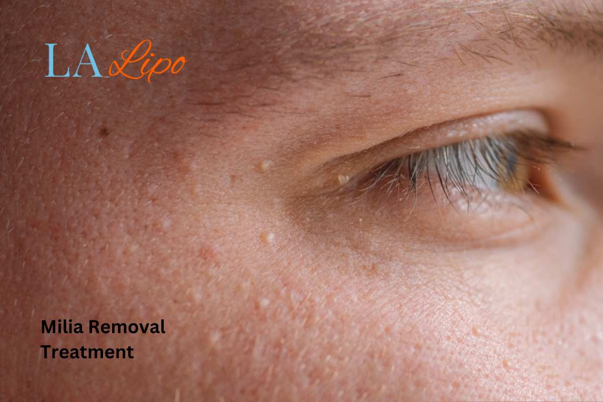 Cryopen Milia Removal: Is It the Easiest and Safest Option Malmesbury?
