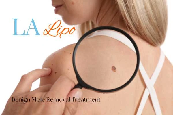 Woman having her inspection of blemish before mole removal Malmesbury