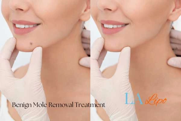 Before and after mole removal Malmesbury treatment
