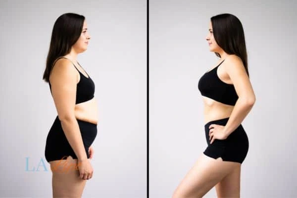 image of woman before and after results of LA-EMS Body Sculpting Malmesbury to help treat Diastasis recti