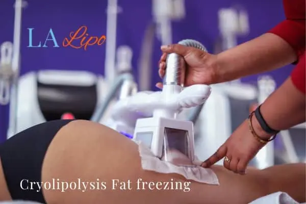 women getting fat freezing Malmesbury