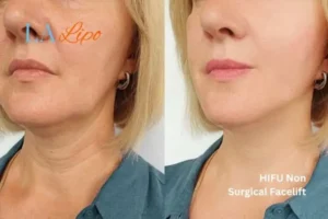 hi-fu for wrinkles Malmesbury before and after results