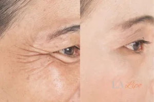 Before and after results of woman - HI-fu wrinkles reduction treatment Malmesbury