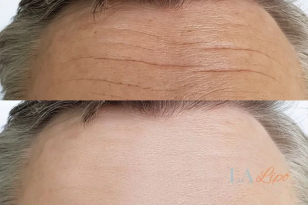 results of HIFU Malmesbury on mans forehead to help reduce lines and wrinkles