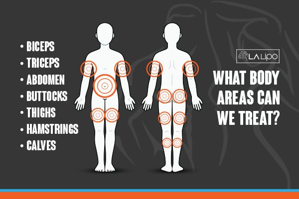Graphic to show areas you can have LA-EMS Body Sculpting Malmesbury treatment.