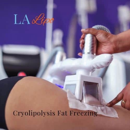 fat freezing - Cryolipolysis Malmesbury
