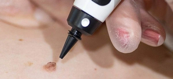 skin tag removal using cryopen Malmesbury