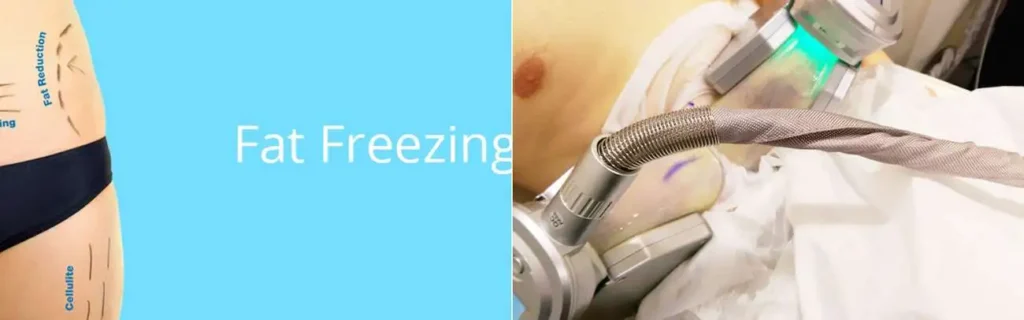 Fat freezing Malmesbury on multiple areas of the body