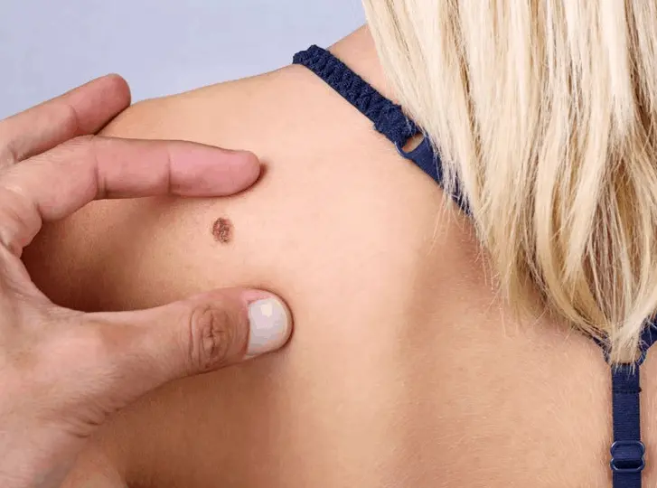 woman having mole removal Malmesbury consultation before treatment.