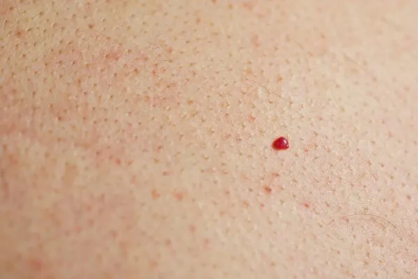 close up of a cherry angioma Malmesbury