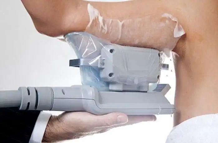 Picture of fat freezing Malmesbury on the upper arms.