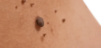 image of a skin tag Malmesbury