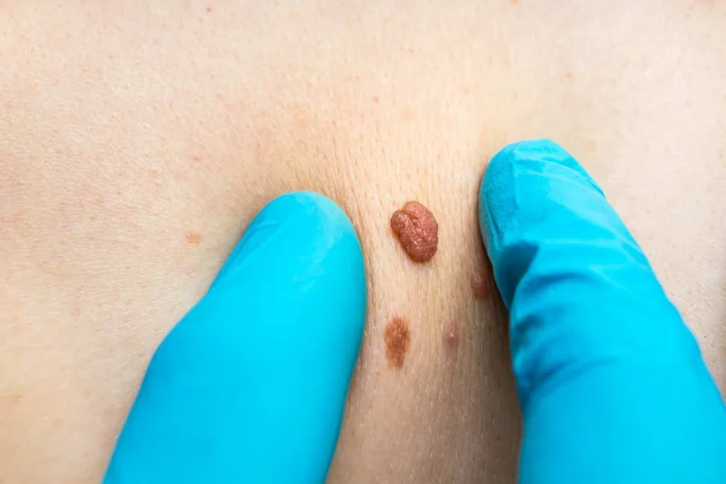 Consultant examining a skin tag Malmesbury