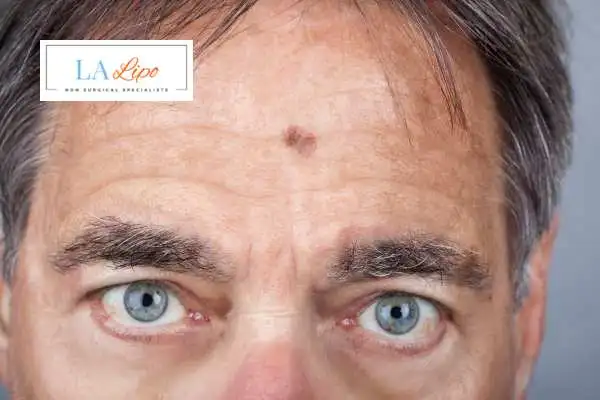 Solar Lentigo Removal Malmesbury image of man with mark on his forehead