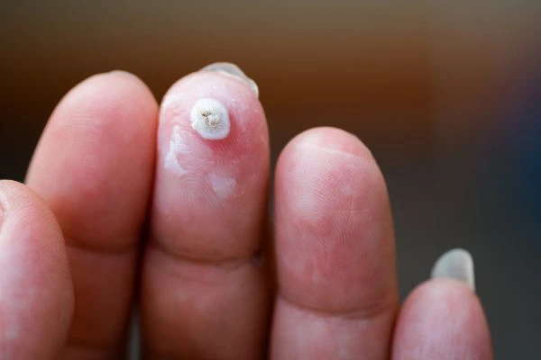 wart on person finger - cryotherapy to treat from LA LIPO Malmesbury