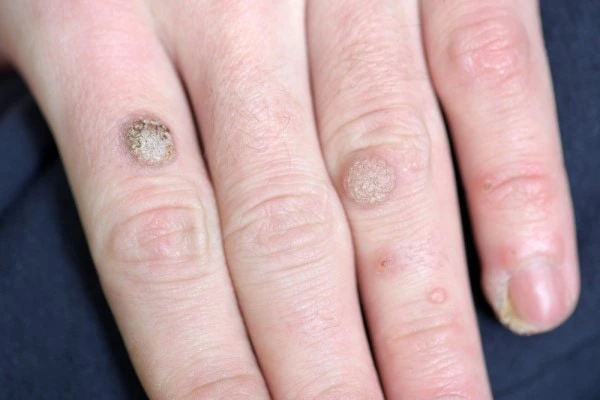 photo of warts on person hand - see wart removal Malmesbury from LA LIPO