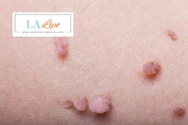 Does cryopen skin tag removal Malmesbury hurt? Find out now call our team today!