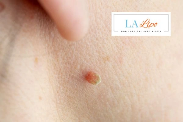 Book skin tag removal Malmesbury today speak to our team now!