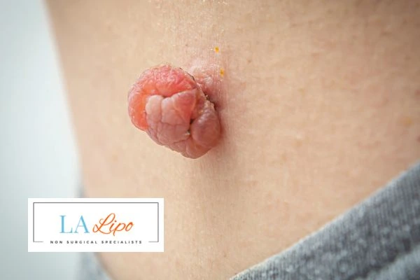 Interested in skin tag removal Malmesbury? Concerned about the pain? Find out more today!