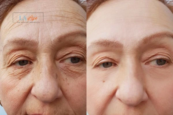 The powerful benefits of Morpheus8 Treatment Malmesbury - Call Our team today!