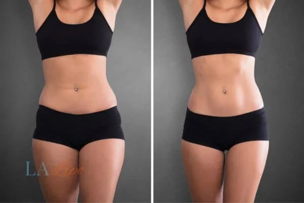 before and after results of non-surgical treatment to help a woman's body image and mental health Malmesbury