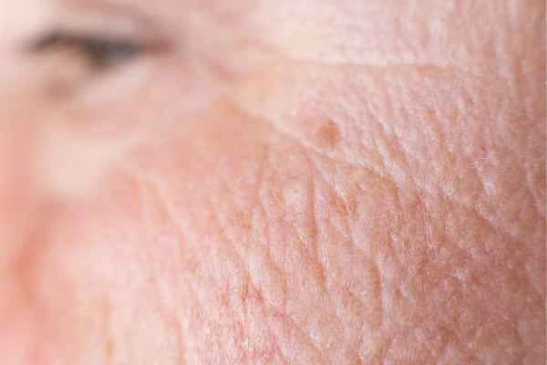 close up picture of a woman's face showing an age spot Malmesbury