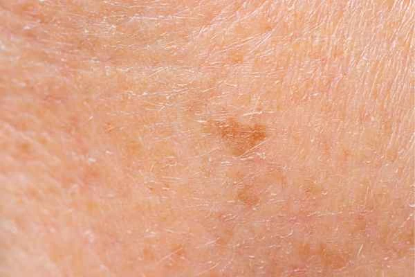 close up picture of age spots Malmesbury