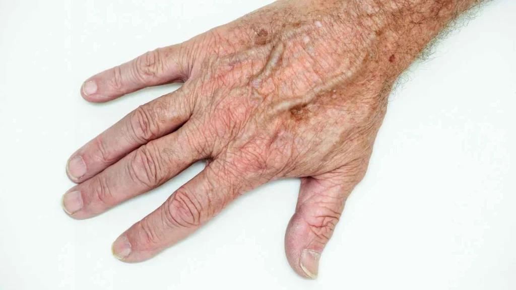 Male hand showing age spot Malmesbury