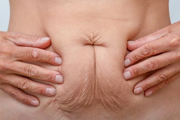 Image of a woman's stomach with loose skin - example of skin tightening Malmesbury options